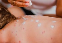 Incremento en las muertes por sarampión en México